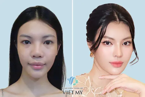 Á hậu chuyển giới Tường San phẫu thuật thẩm mỹ những gì và ở đâu?