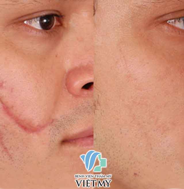 Laser Treatment for acne, bad scars, stretch marks