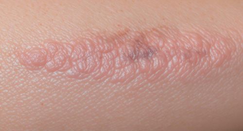 Nâng ngực có để lại sẹo không? Giải pháp nâng ngực hạn chế sẹo