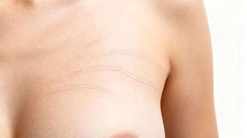 Nâng ngực bị rạn da phải làm sao? Cách xử lý khi gặp tình trạng này