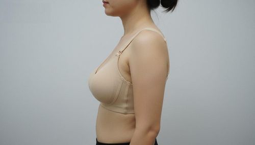 Nâng ngực treo sa trễ được bao lâu? Cách duy trì kết quả lâu dài
