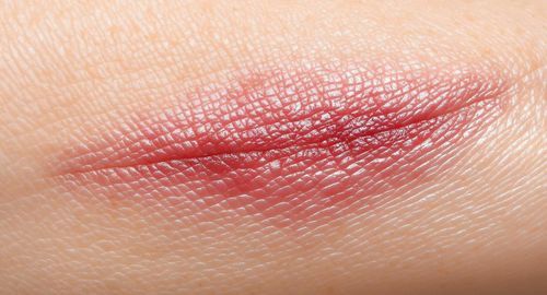 Nâng ngực bao lâu được hút thuốc? Tác hại và lưu ý trong quá trình phục hồi 