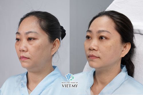 Vì sao nên thực hiện Ultherapy Prime tại bệnh viện thẩm mỹ Việt Mỹ
