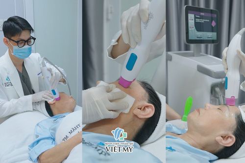Làm Thermage FLX một lần hiệu quả duy trì được bao lâu?