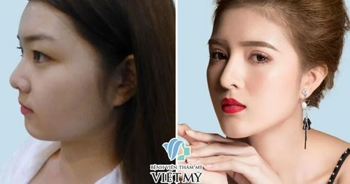 Nâng mũi cấu trúc - Bác sĩ Chiêm Quốc Thái