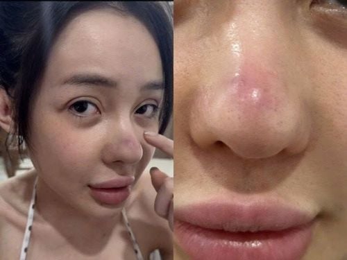 Mũi biến dạng của Ngân 98 hiện tại nên xử lý như thế nào là tốt nhất