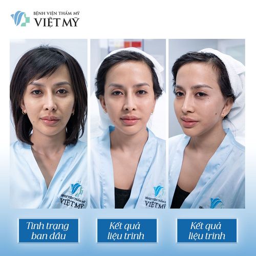 Những ai nên làm Ultherapy Prime để trẻ hóa da mặt