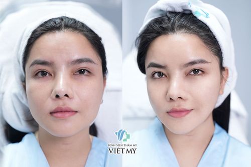 Sau khi làm Ultherapy Prime cần chăm sóc da như thế nào?