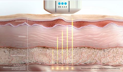 Vì sao Ultherapy Prime được gọi là "chuẩn vàng" nâng cơ không phẫu thuật