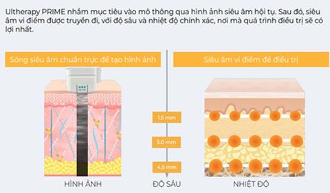 Vì sao Ultherapy Prime được gọi là "chuẩn vàng" nâng cơ không phẫu thuật