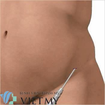 Mỡ được lấy từ những vùng như eo, bụng, hông hoặc đùi để cấy vào ngực.