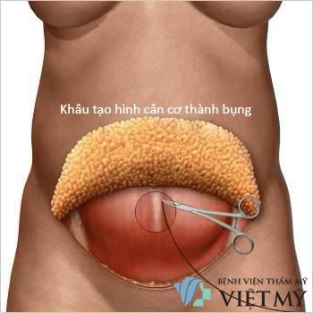 khâu tạo hình cân cơ bụng