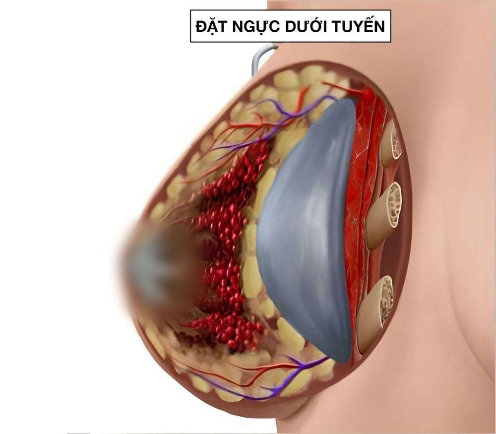 Vị trí đặt túi ngực dưới tuyến