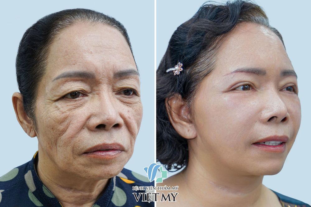 Khách hàng 70 tuổi treo chân mày, căng da mặt, cắt mí dưới và tiêm mờ rãnh mũi má