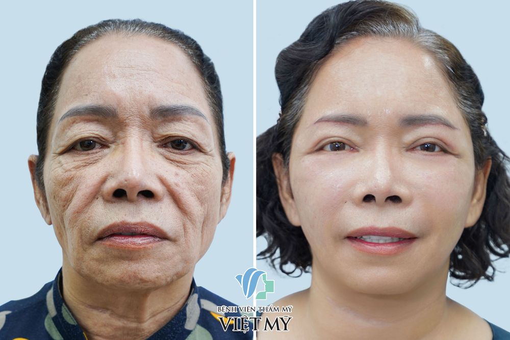 Treo chân mày - bác sĩ Chiêm Quốc Thái