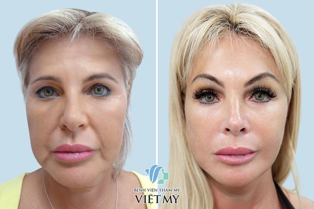 Khách hàng U60 căng da mặt