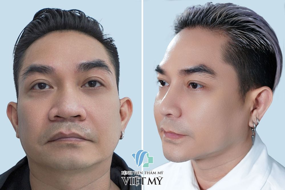 Nâng Mũi Hàn Quốc S Line - Bác sĩ Chiêm Quốc Thái