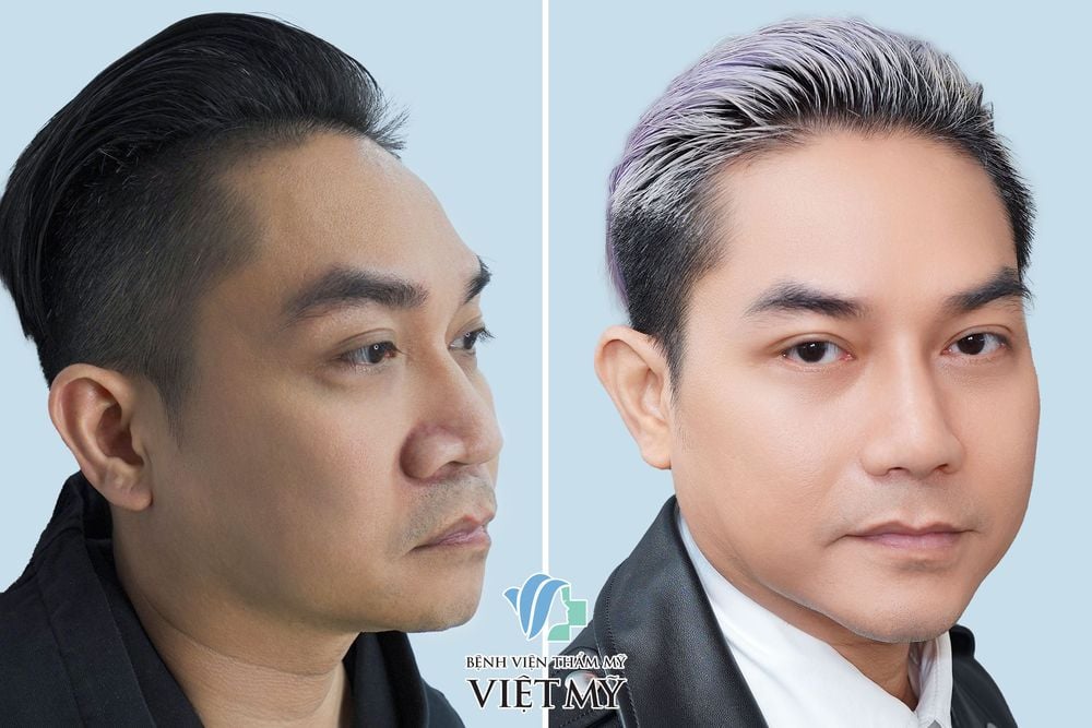 Ca sĩ Phạm Khánh Hưng trước và sau khi nâng mũi, thu gọn cánh mũi, nâng cằm và cắt mí dưới