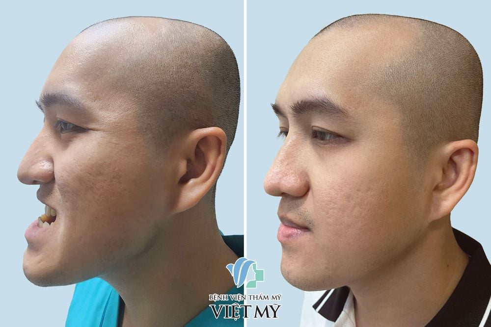 tạo hình hàm móm