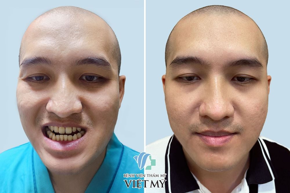 tạo hình hàm móm