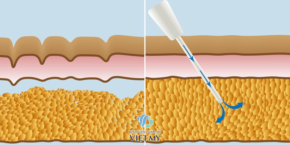 cấy mỡ tự thân giúp làm đầy khu vực điều trị