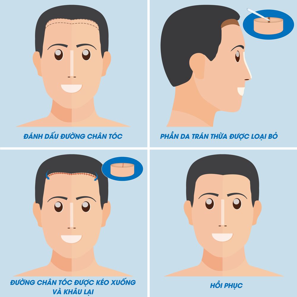 phẫu thuật hạ đường chân tóc