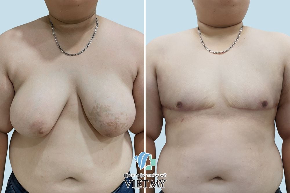 tạo hình ngực nam