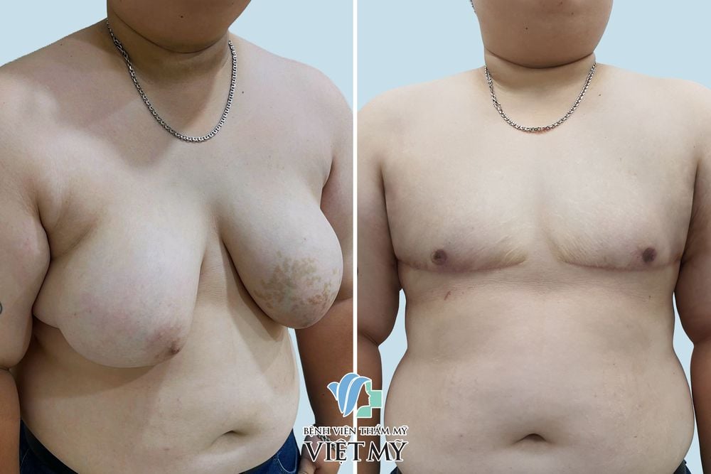 cắt tuyết vú