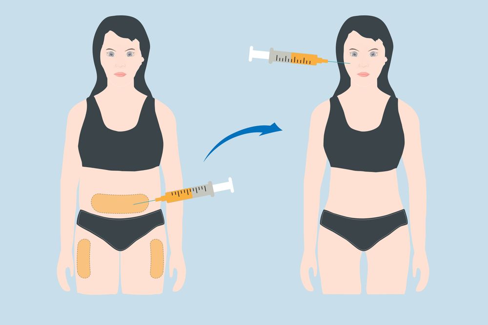 Mỡ được thu hoạch tại bụng hoặc đùi và cấy để trẻ hóa mặt