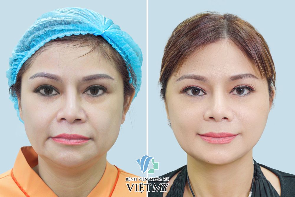 Căng da mặt bằng chỉ - bác sĩ Chiêm Quốc Thái - căng da mặt chỉ Collagen - căng da mặt chỉ vàng -chỉ The Up
