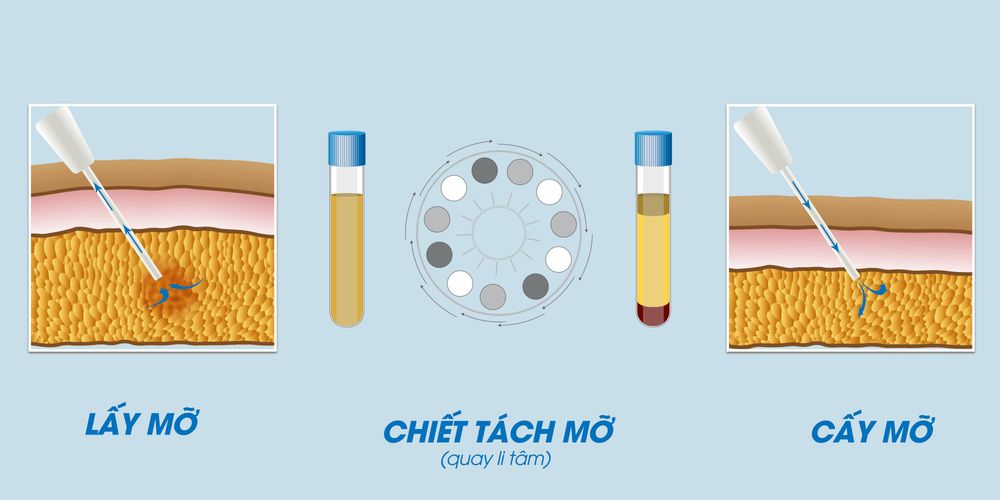 Quy trình điều trị cấy mỡ trẻ hóa khuôn mặt