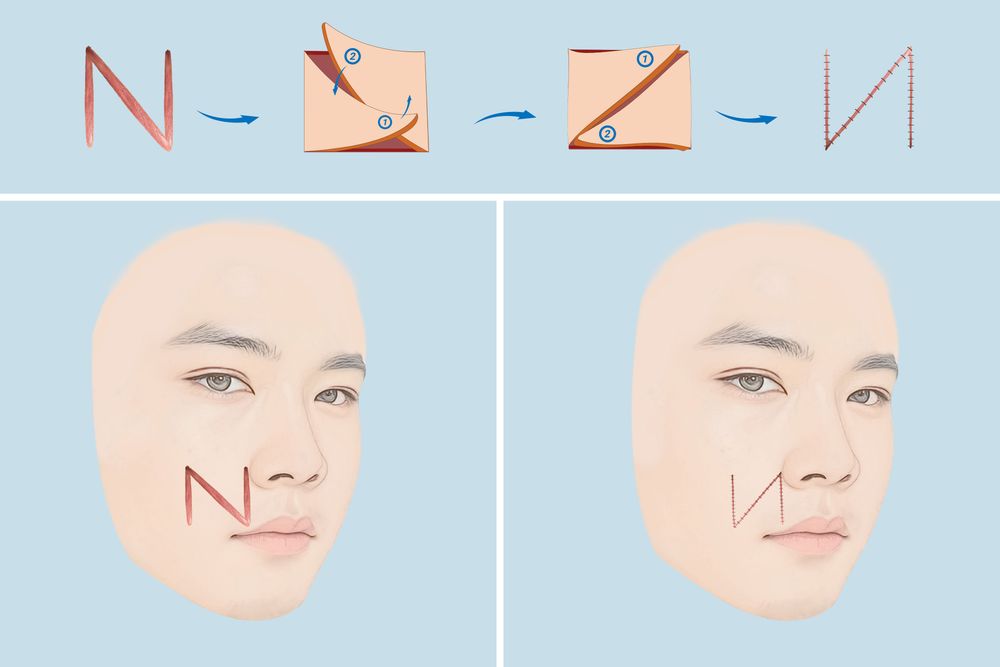Mô phỏng chuyển hướng sẹo trên khuôn mặt nằm dọc theo đường mũi má