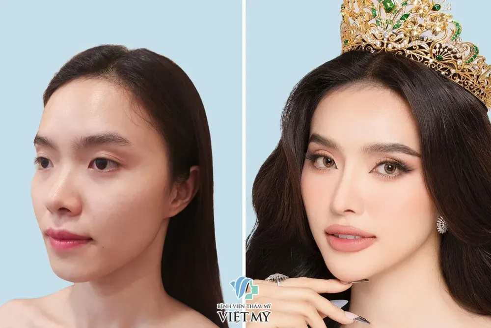 Á hậu 1 Miss Grand Vietnam 2024 Hạnh Nguyên trước và sau nâng mũi cấu trúc.