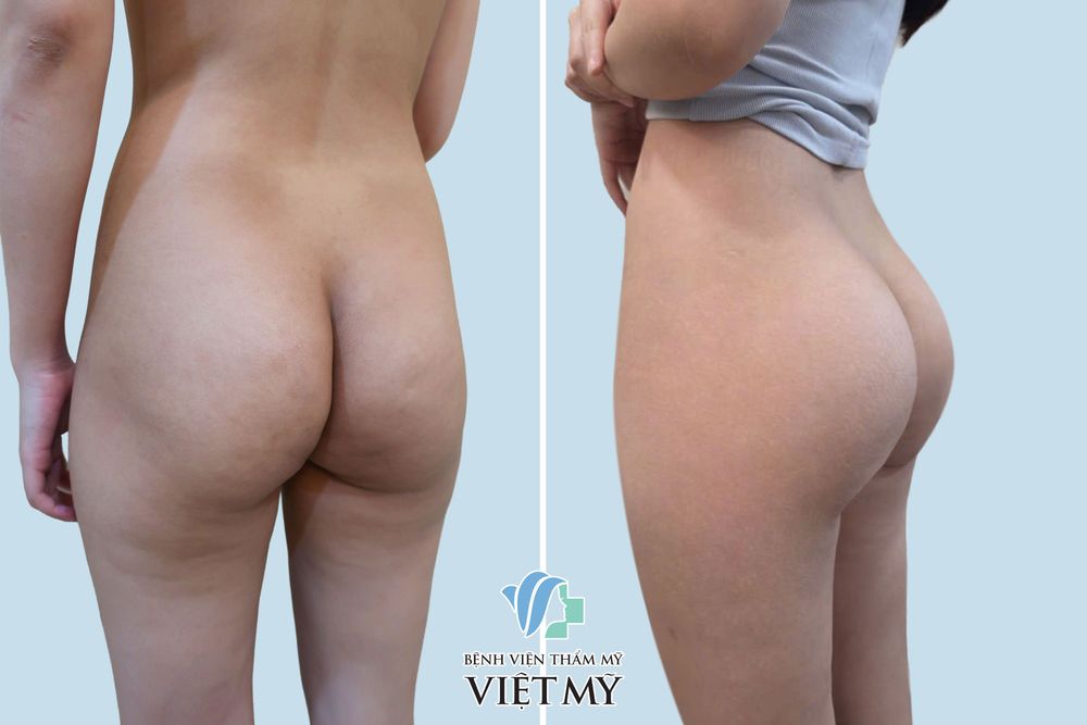 Hình ảnh trước và sau khách hàng nâng mông nội soi, hút mỡ eo