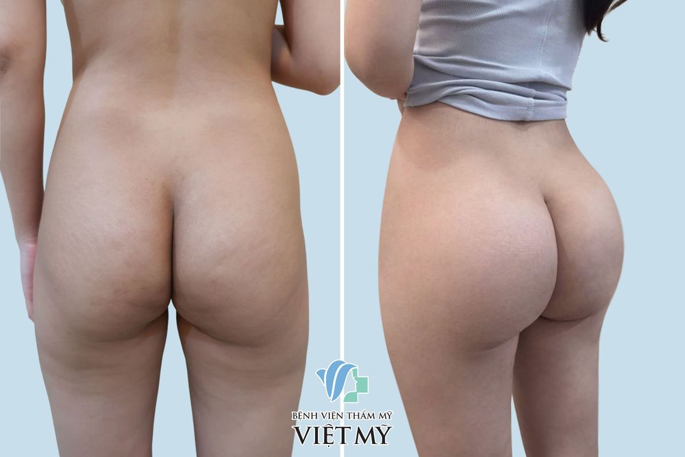 Hình ảnh trước và sau khách hàng nâng mông nội soi, hút mỡ eo