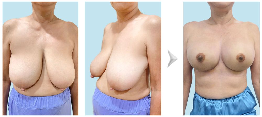Hình ảnh trước và sau khách hàng ngực xệ không đường sẹo dọc