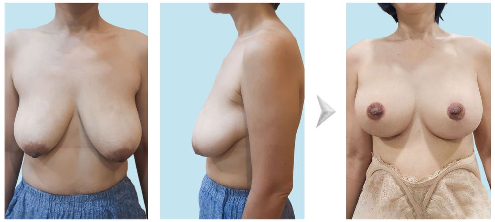 Hình ảnh trước và sau khách hàng ngực xệ không đường sẹo dọc