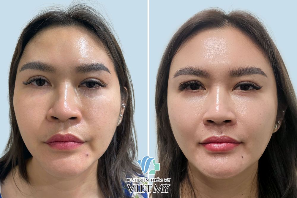 Khách hàng trước và sau khi được tiêm mỡ thái dương - trán