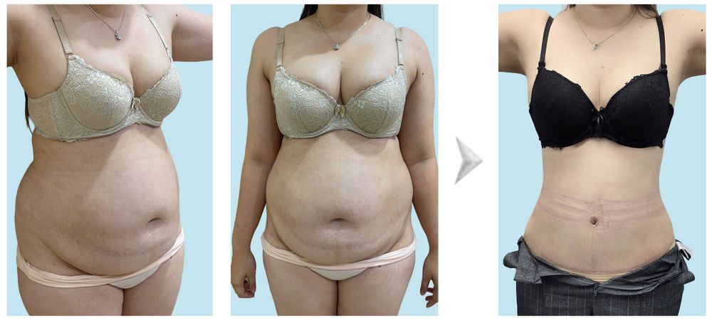 Hình ảnh khách hàng trước và sau hút mỡ bụng, căng da bụng vừa cắt chỉ sau 10 ngày.