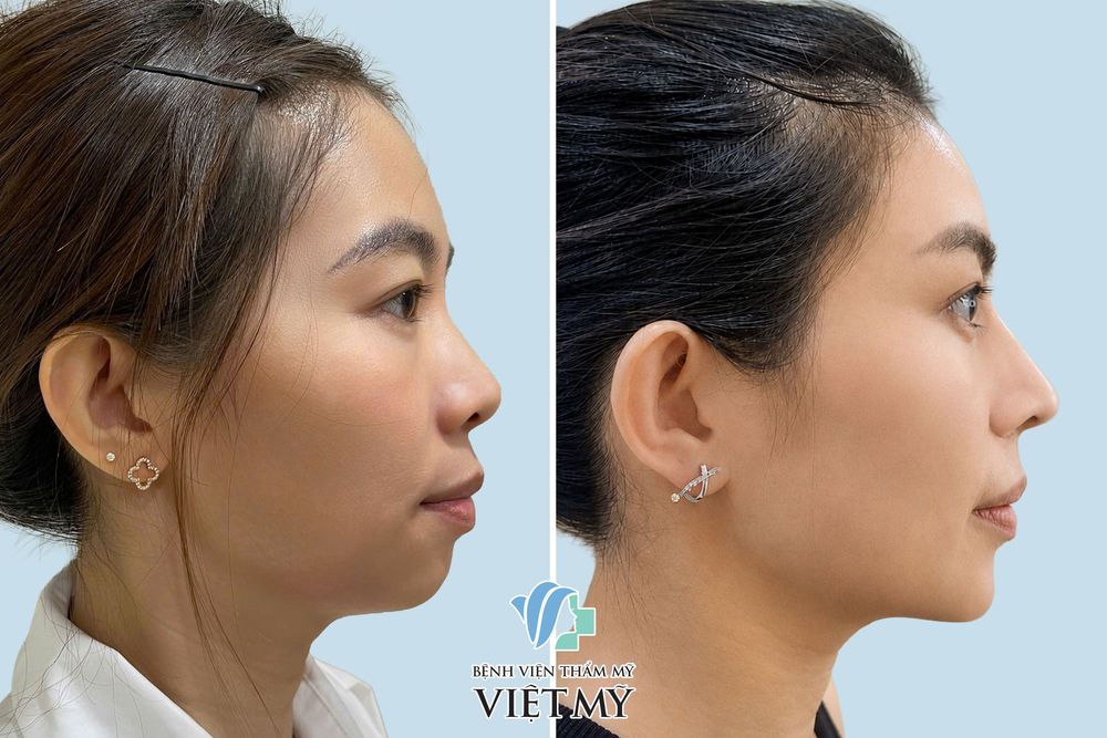 Hình ảnh khách hàng trước và sau nâng cằm