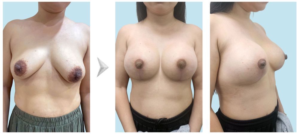Hình ảnh trước và sau khách hàng nâng ngực, thu da vợt