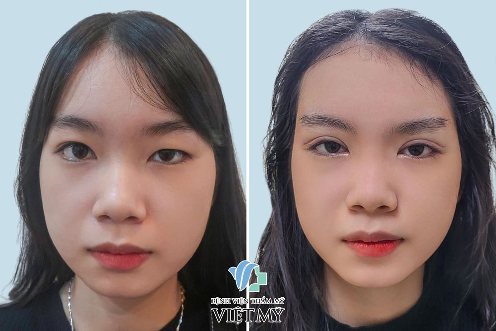 Hình ảnh khách hàng trước / sau cắt mí mắt và mở rộng góc mắt sau 2 ngày