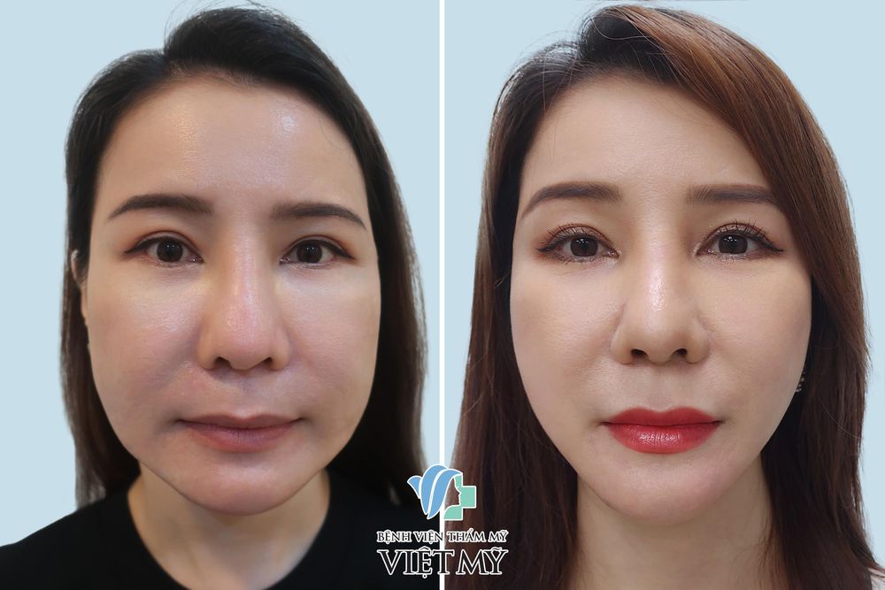 Hình ảnh khách hàng trước và sau gọt góc hàm (thon gọn mặt)