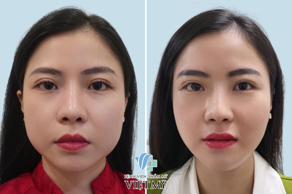 Hình ảnh khách hàng trước và sau gọt góc hàm (thon gọn mặt)