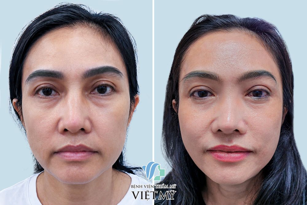 Hình ảnh trước và sau khách hàng tiêm mỡ hốc mắt bằng mỡ tự thân