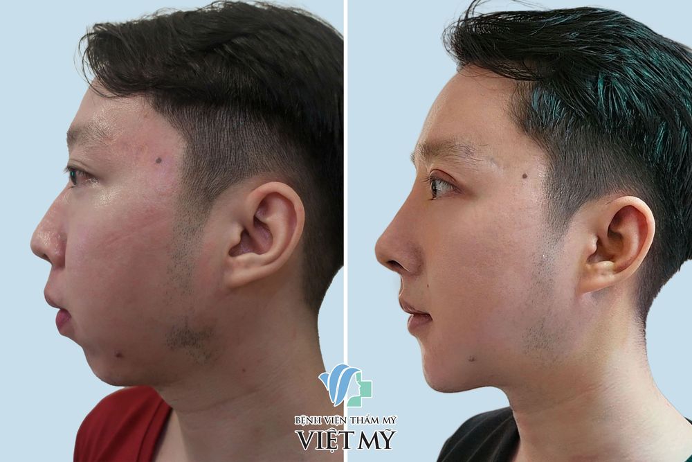 Hình ảnh khách hàng trước và sau trượt cằm, cắt mắt sau 1 tuần
