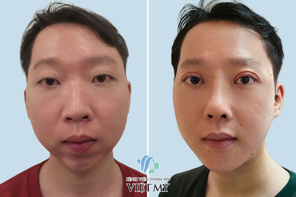 Hình ảnh khách hàng trước và sau trượt cằm, cắt mắt sau 1 tuần