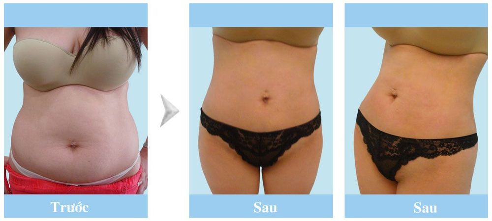 hình ảnh trước sau hút mỡ bụng