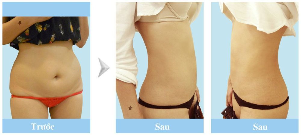 hình ảnh trước sau hút mỡ bụng