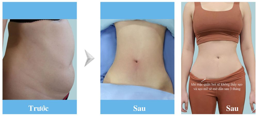 hình ảnh trước sau hút mỡ bụng sau 1 tháng